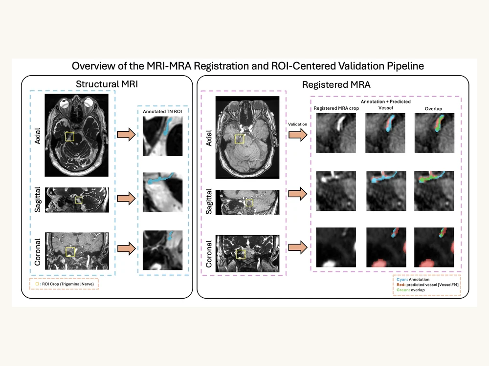 Pipeline diagram: structural MRI with an annotated trigeminal ROI, registered MRA, and the overlap between annotation and predicted vessel